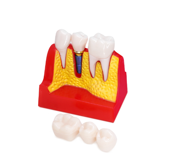 Imagen de Regalo Modelo Didactico De Implantologia Y Protesis Kingden